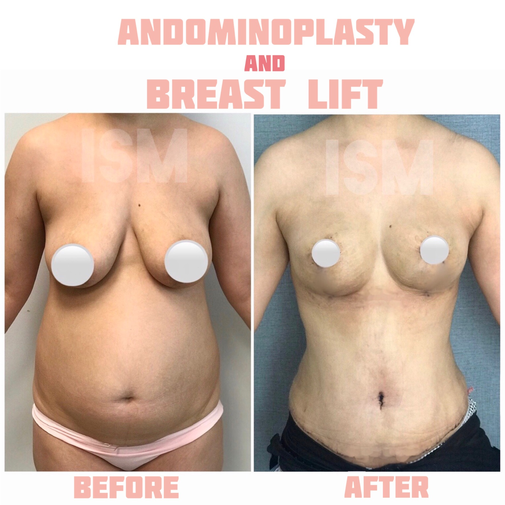 abdominoplasty-breast-lift-1