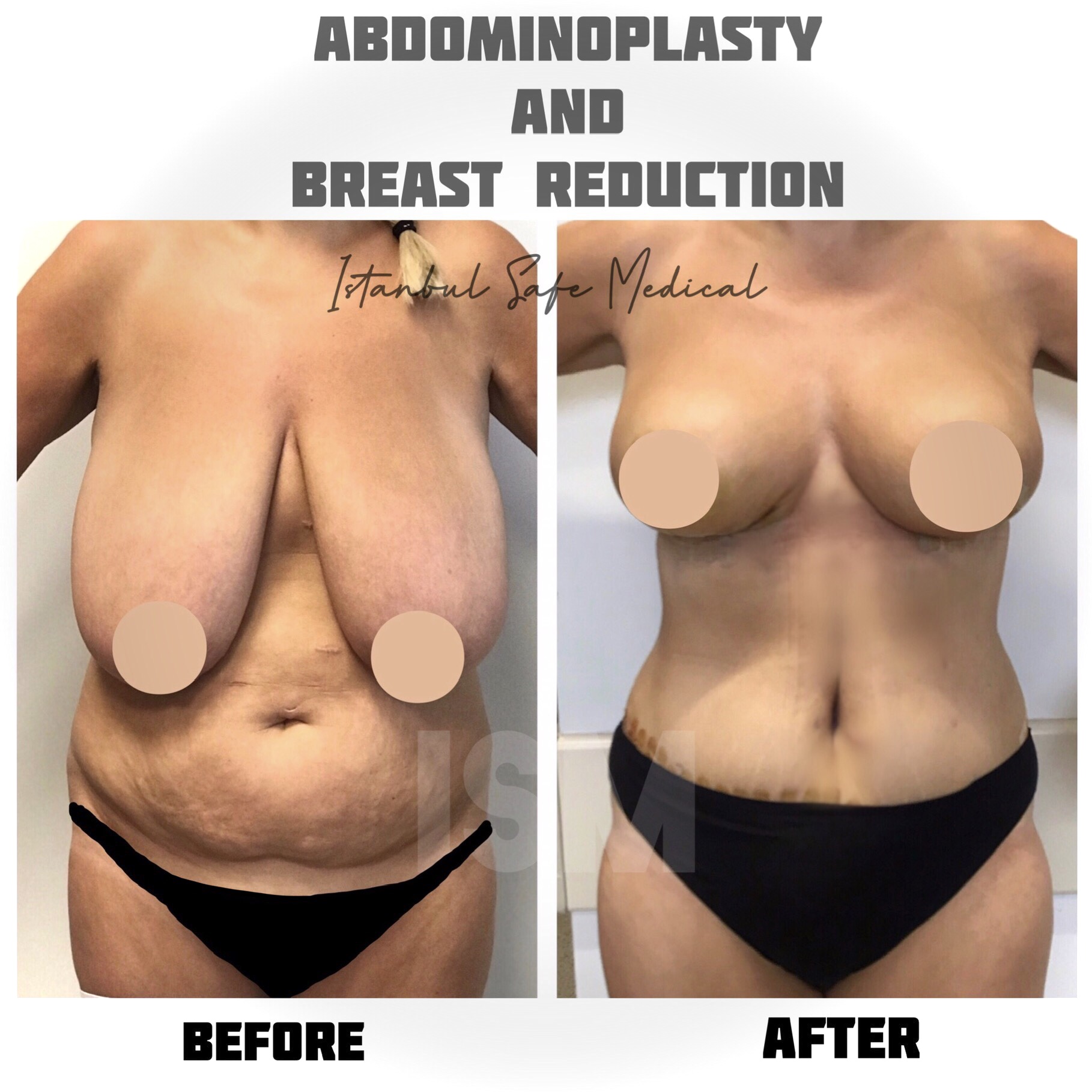 abdominplasty-breast-reduction