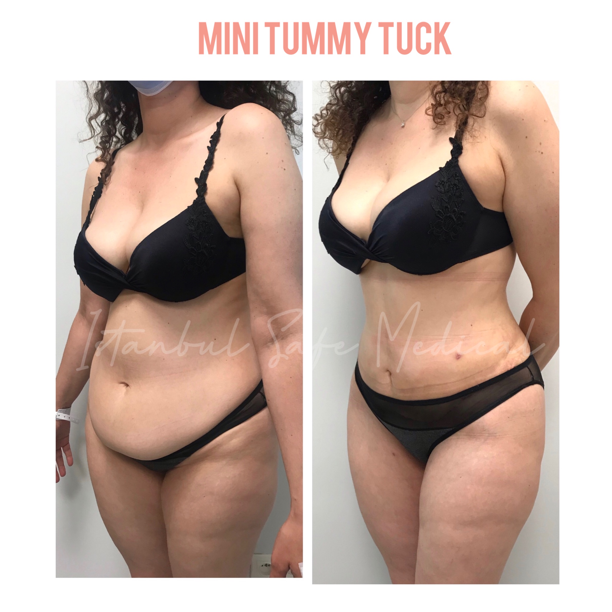 mini-tummy-tuck