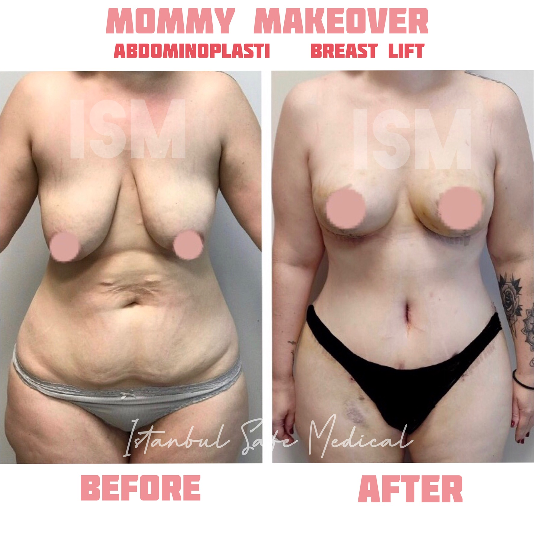 mommy-makeover-7